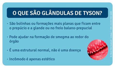 que son glandulas de tyson|Glándulas de Tyson: Factores de Riesgo, Causas, Síntomas,。